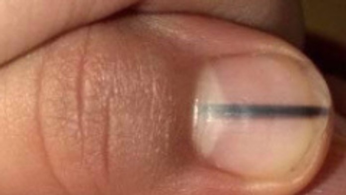 Manikérka ju upozornila na zvláštnosť na nechte, vykľula sa z toho rakovina