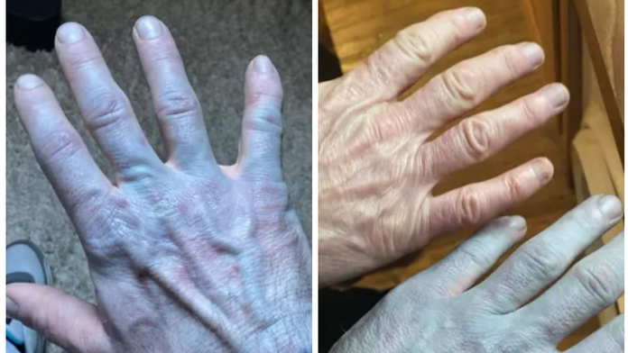 Muž sa zobudil a zistil, že je celý modrý. Príčina dostala do kolien aj lekárov