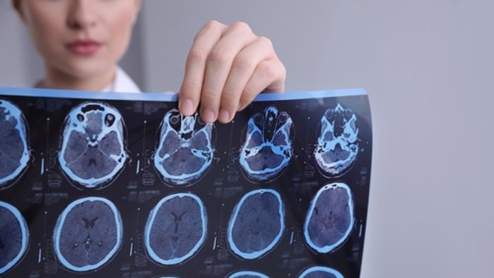 Vedci odhalili bunky, ktoré ničia mozog. Objav môže zmeniť liečbu sklerózy