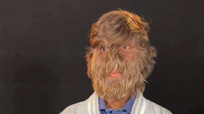 Mladík má vzácny vlkolačí syndróm. Získal vďaka tomu svetový rekord