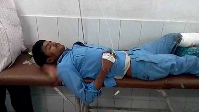 Ind má ako vankúš vlastnú amputovanú nohu