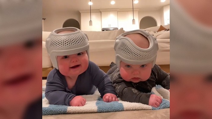 Liečba plochej lebky pomocou prilby. 