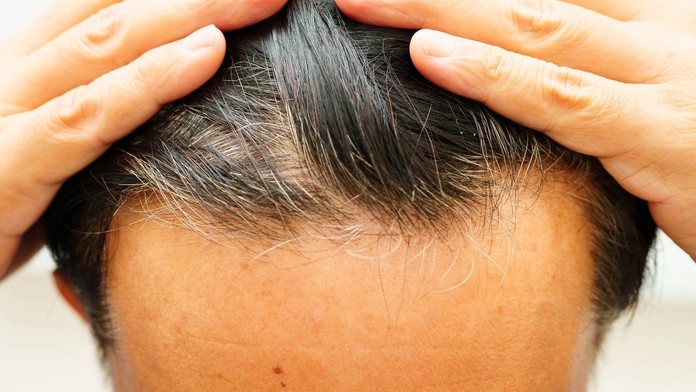 Známy liek proti vypadávaniu vlasov môže vyvolať myšlienky na samovraždu. Predajcovia podceňujú riziká