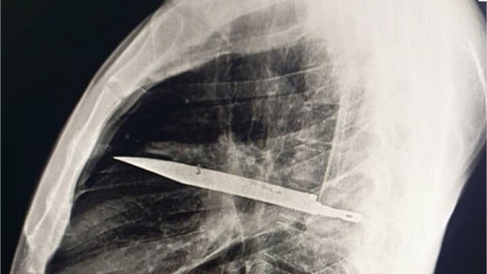 Prípad, ktorý šokoval lekárov. Muž žil osem rokov s nožom v hrudi