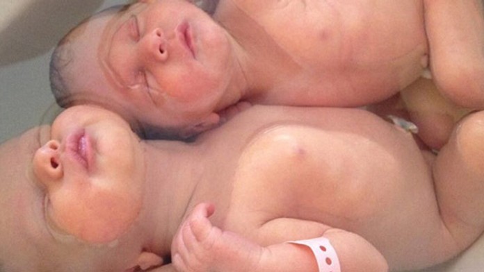 Dvojčatá sa hneď po pôrode k sebe túlia