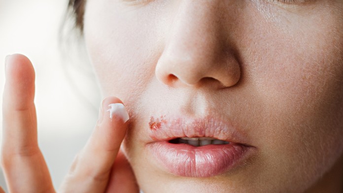 Bolestivé opary: Zistite, prečo vznikajú a ako ich môžete účinne vyliečiť