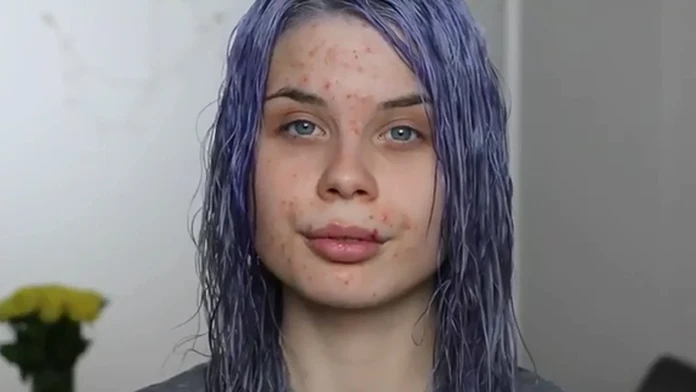 Slovenka Radka Kováčová chcela pomôcť dievčatám, ktoré majú akné.