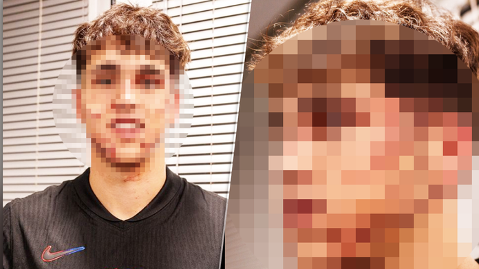 VIDEO: Vydesil fanúšikov, zápas nedohral. Mladá nádej Barcelony odchádzala z ihriska so zakrvavenou tvárou