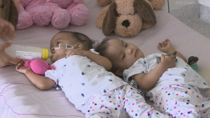 Siamské dvojčatá z Bhutánu 