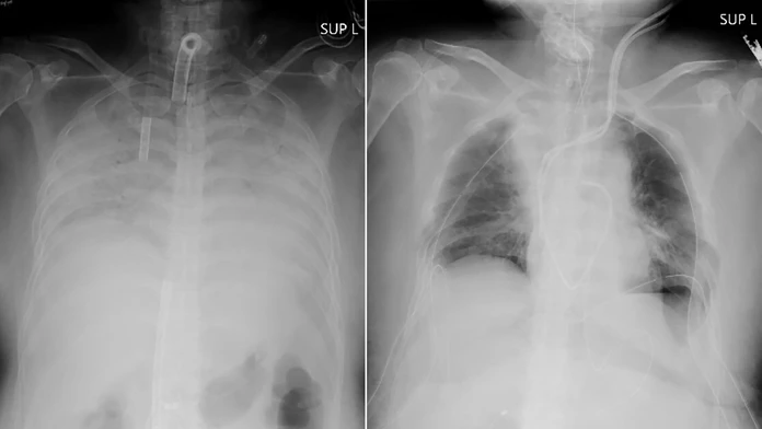 Pľúca pacientky pred transplantáciou a po nej