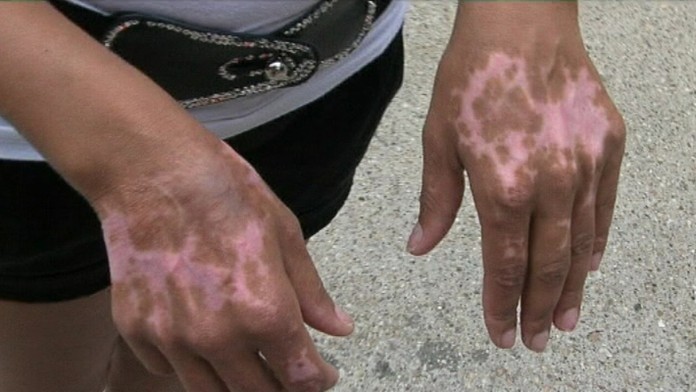 19 LV Popalena zena sa zotavuje.transferweb_jpg_bez_watermarku_1.jpg