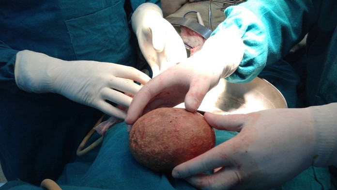 Indovi vytiahli z tela najväčší močový kameň