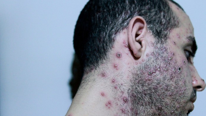 Veľká Británia potvrdila komunitné šírenie opičích kiahní