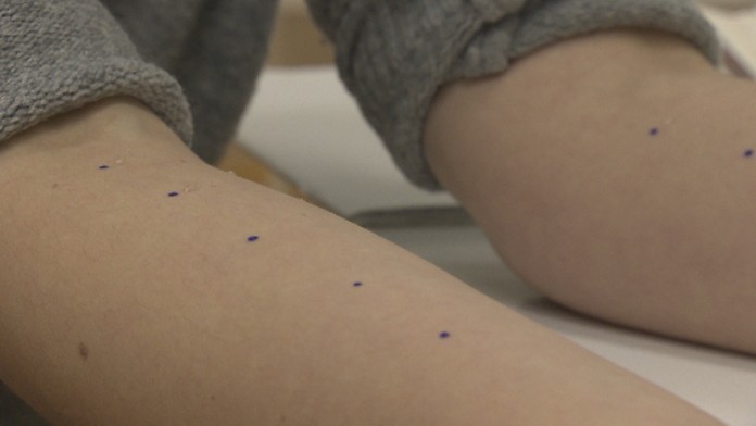 Kožný test na alergiu.