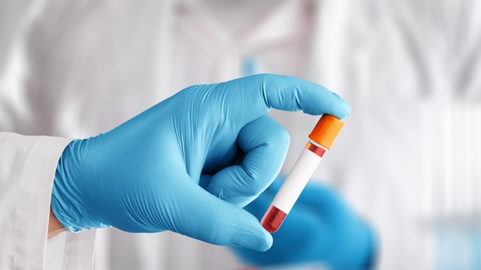 Na prahu revolúcie v medicíne: Krvný test, ktorý rozpozná 50 druhov rakoviny, má sľubné výsledky