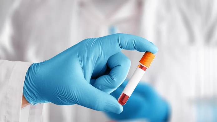 Na prahu revolúcie v medicíne: Krvný test, ktorý rozpozná 50 druhov rakoviny, má sľubné výsledky