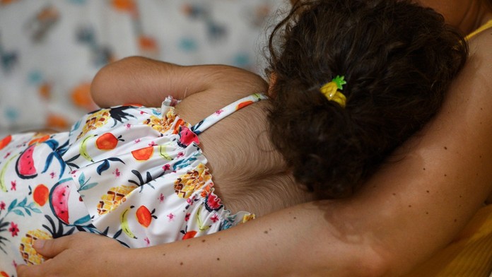 Dojčatá v Španielsku postihuje vzácny „vlkolačí syndróm“. Môže za to liek, ktorý užívajú ich rodičia