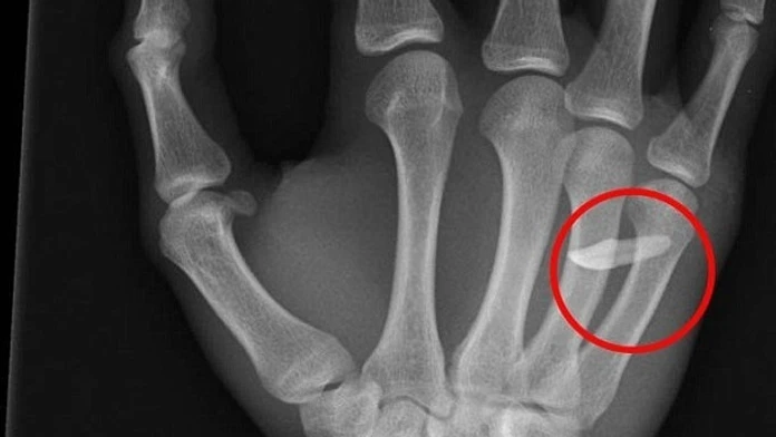 2859C96A00000578-3069003-A_teenager_who_came_to_hospital_with_a_swollen_hand_was_found_to-a-147_1430843965301.jpg