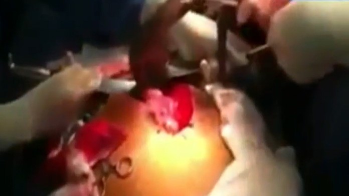 Mužovi vytiahli z brucha živú rybu.