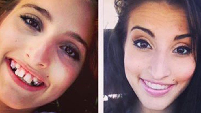 Dievča opeknelo vďaka strojčeku na zuby