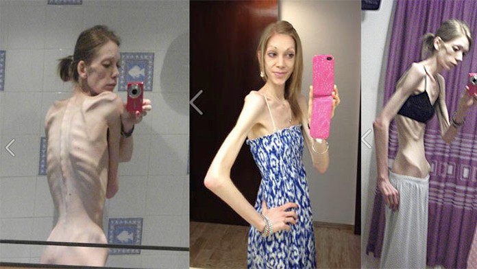 Jej príbeh je inšpiráciou pre mnohé dievčatá, ktoré bojujú s poruchami príjmu potravy.