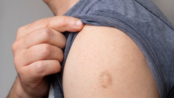 Jazva po očkovaní.