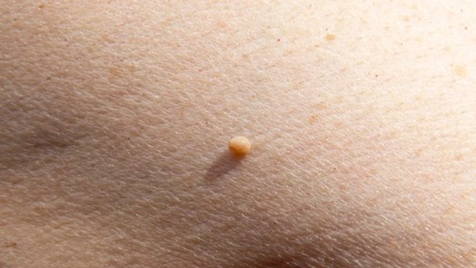 Malé kožné výrastky vyzerajú nevinne. Dermatologička varuje pred ich domácim odstraňovaním