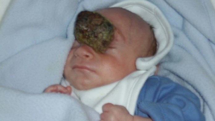 Jamie sa narodil s anomáliou zvanou encefalokéla.