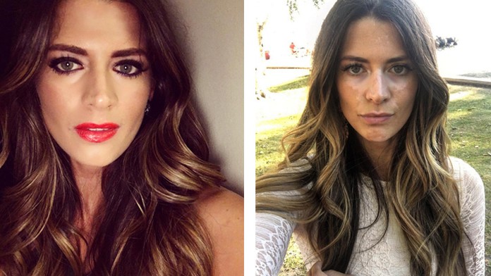 Modelka Breanne Rice sa rozhodla ukázať kožnú chorobu.