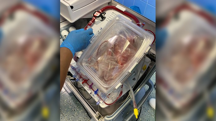 Na snímke transplantované srdce.