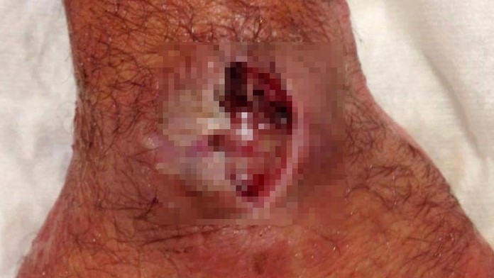 Takto vyzerala jeho silná alergická reakcia. 