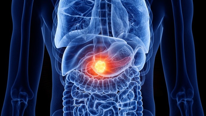 Rakovina pankreasu je jedným z najzákernejších onkologických ochorení. Týchto desať príznakov by ste nemali ignorovať