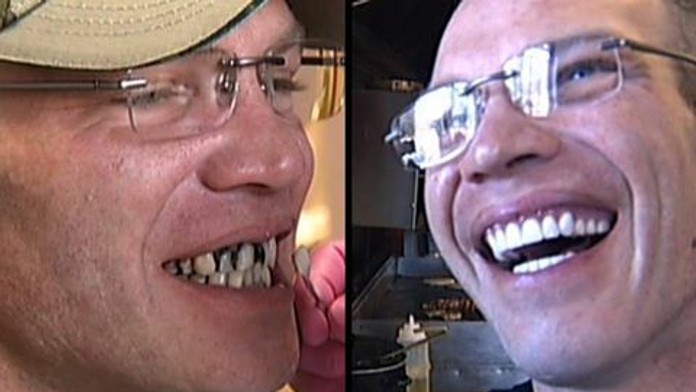 Brianov úsmev pred a po zákroku.