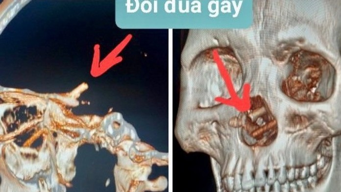 Muž žil mesiace s bolesťami hlavy. Keď si lekári pozreli CT snímku, neveriacky si pretierali oči