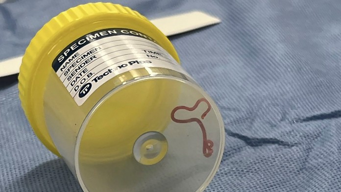 FOTO:  Lekári vyoperovali z mozgu seniorky živého osemcentimetrového červa