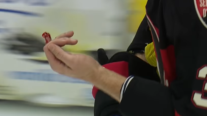 Zranený prst Marka Methota.