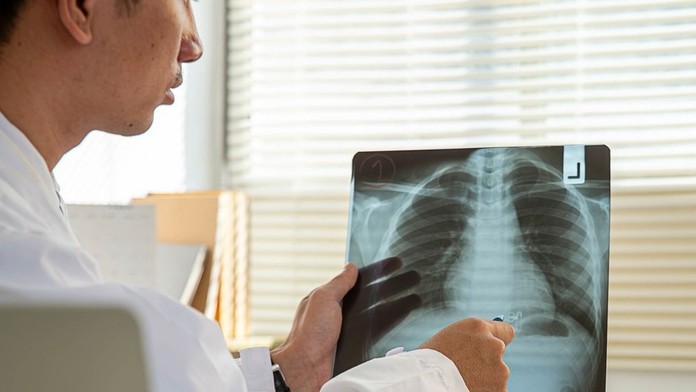 S prípadom chlapca, ktorý vykašliaval krv, si lekári dlho nevedeli rady. V pľúcach objavili nečakaného votrelca