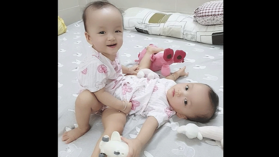 Lekárom sa podarilo úspešne oddeliť siamské dvojičky