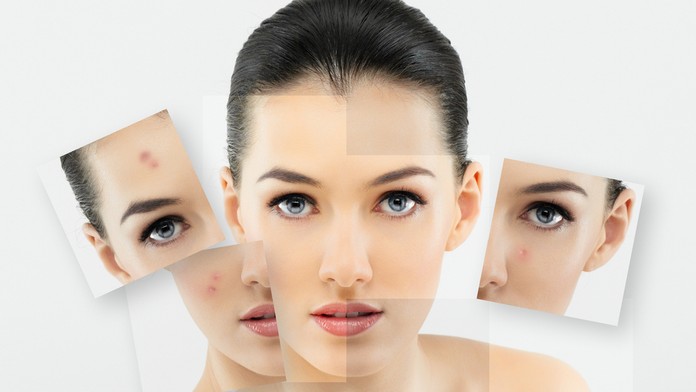 Akné - ilustračná snímka