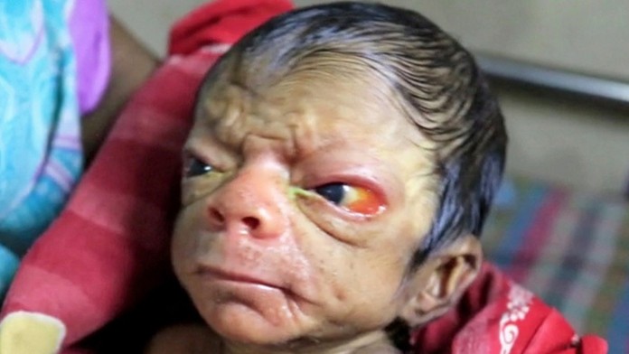 Chlapček sa narodil s tvárou starca.