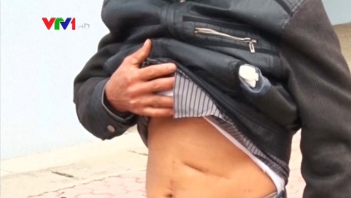 Muž mal v bruchu 18 rokov chirurgické nožnice.