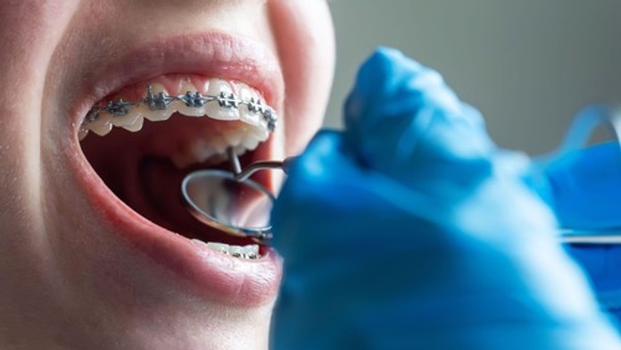 Populárny liek má nečakaný vedľajší účinok. Odborníci varujú pred problémami so zubami