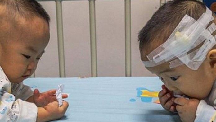 Desaťmesačné dvojčatá trpia vážnou chorobou. 