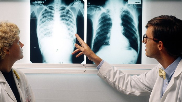 Prípady tuberkulózy medzi deťmi narastajú