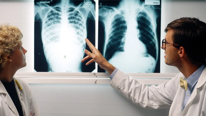 Prípady tuberkulózy medzi deťmi narastajú