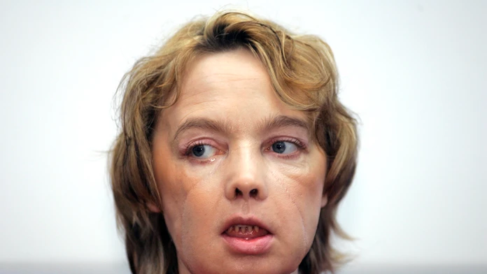 Isabelle Dinoire