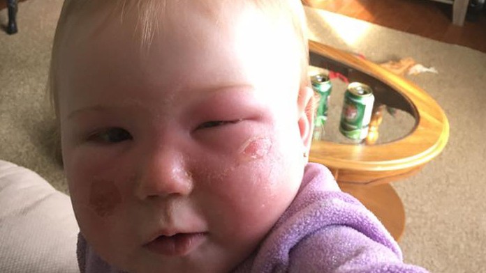 Mamička použila opaľovací sprej pre deti. Dcérka utrpela popáleniny II. stupňa