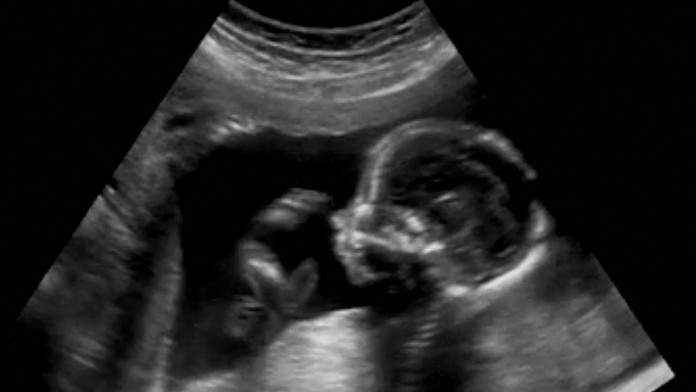 Žena musí vynosiť choré dieťa, aby ho po pôrode pochovala. Pre prísny potratový zákon jej nechcú pomôcť