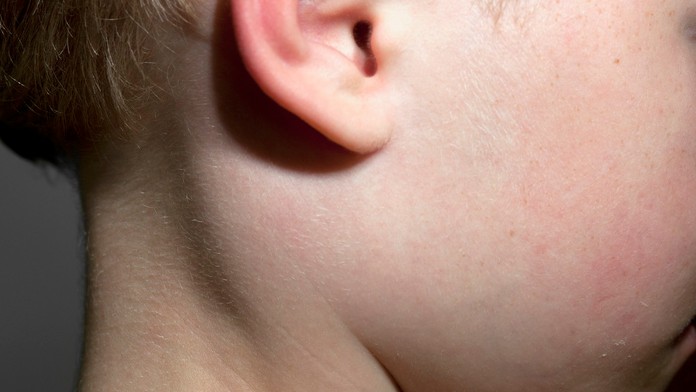 Zápal príušných žliaz.