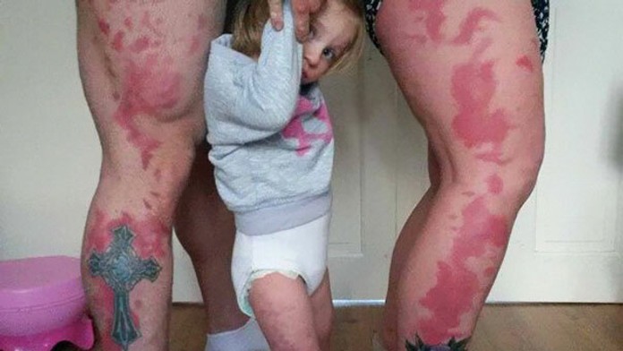 parents-tattoo-toddler-birthmark-honey-rae-4.jpg